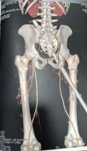 isolated femoral neuropathy
