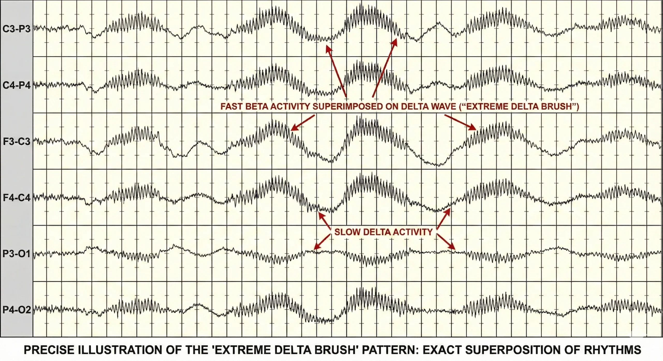 EEG illustration showing fast beta activity superimposed exactly on slow delta waves, known as the extreme delta brush pattern.