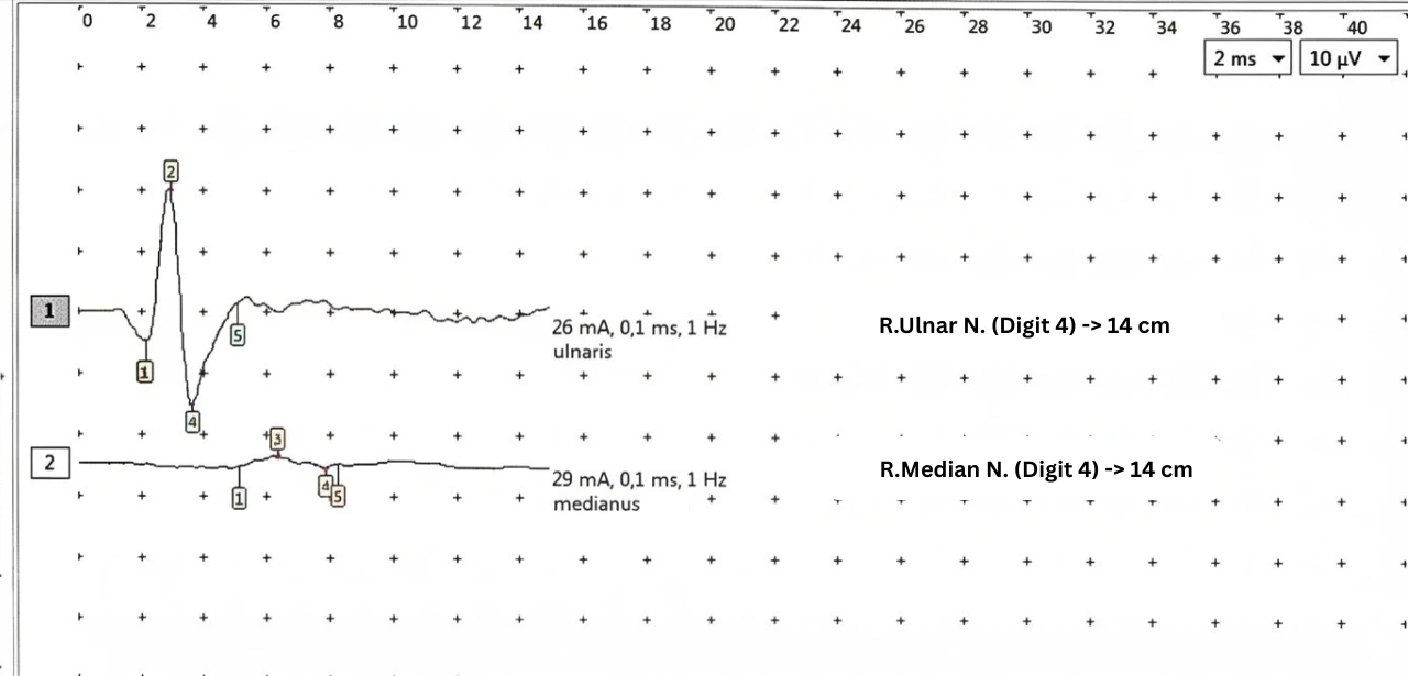 EMG trace comparing median and ulnar sensory nerve action potentials at digit 4 over a 14 cm distance