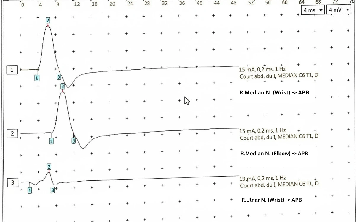 EMG trace showing preserved median motor nerve CMAP amplitudes in pregnancy-related carpal tunnel syndrome