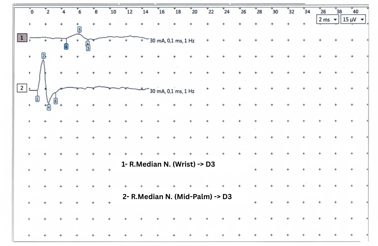 EMG trace showing severe sensory conduction block of the median nerve from palm to wrist in carpal tunnel syndrome